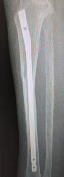 Tibial Nail, Unidentified (Implant 151208)